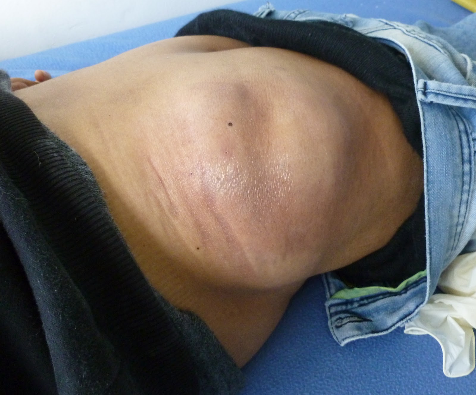 inyeccion encapsulada en el gluteo inyeccion encapsulada en el gluteo